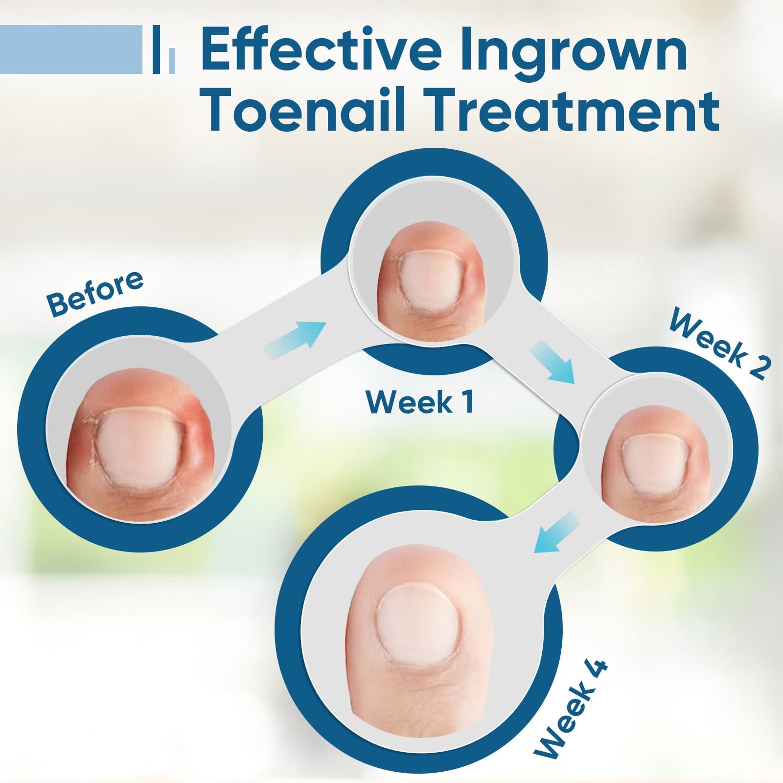 Ingrown Toenail Treatment, Ingrown Toenail Corrector, 30ml