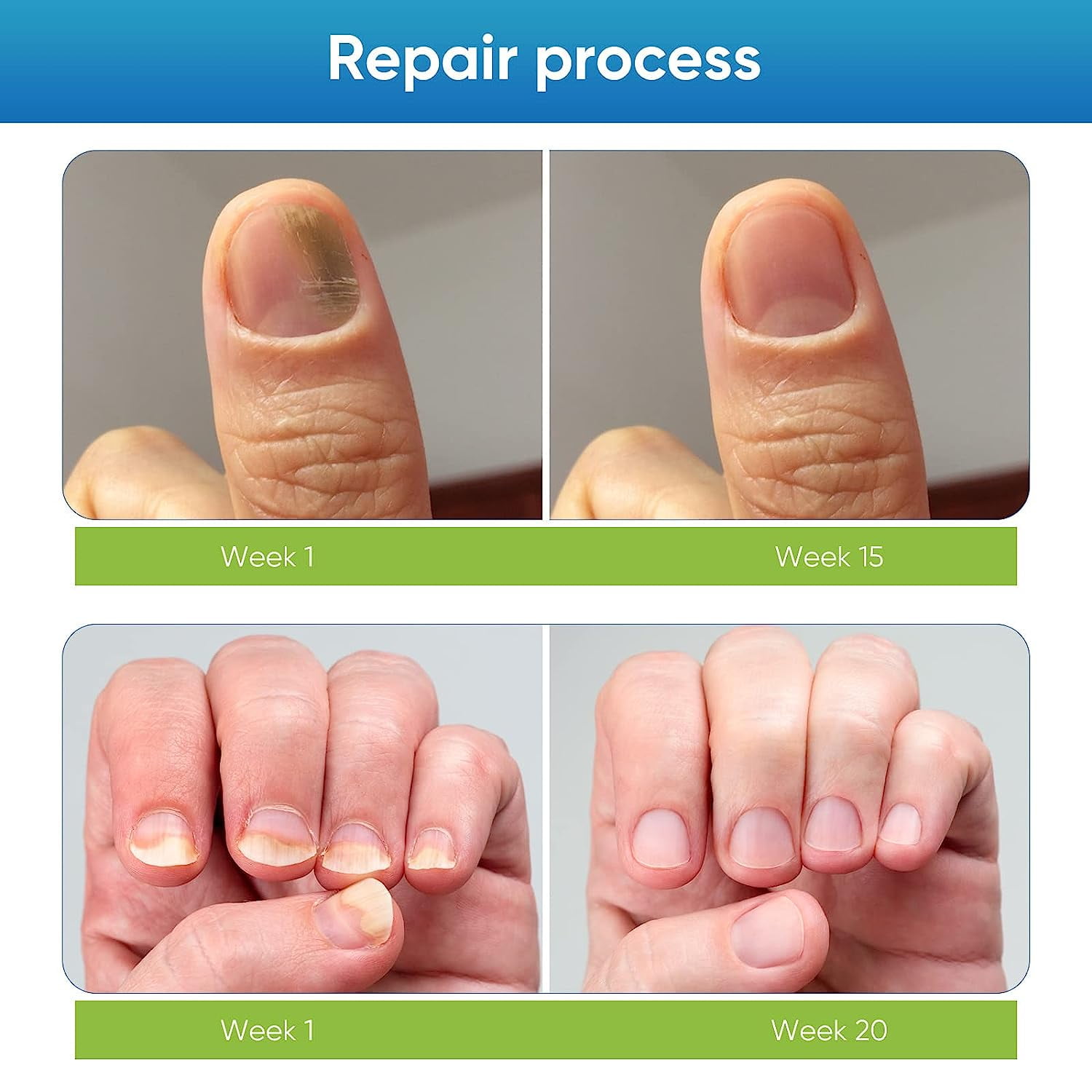 Toenail Fungus Treatment Extra Strength, Nail Repair Liquid for Toenail and Fingernail, Restore Healthy Nails