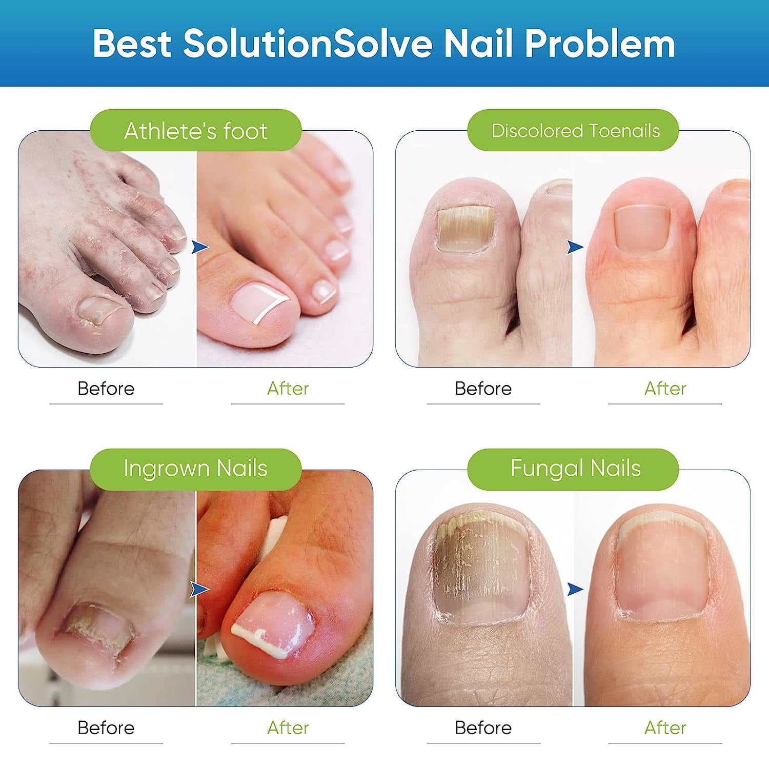 Toenail Fungus Treatment Extra Strength, Nail Repair Liquid for Toenail and Fingernail, Restore Healthy Nails