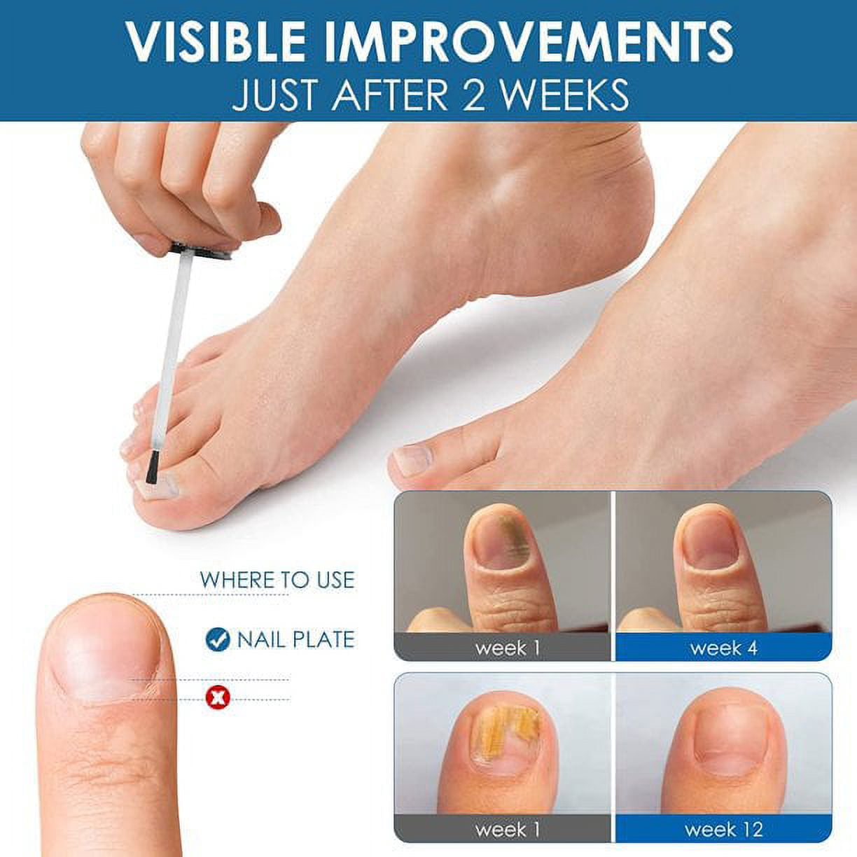 Toenail Fungus Treatment-30ml