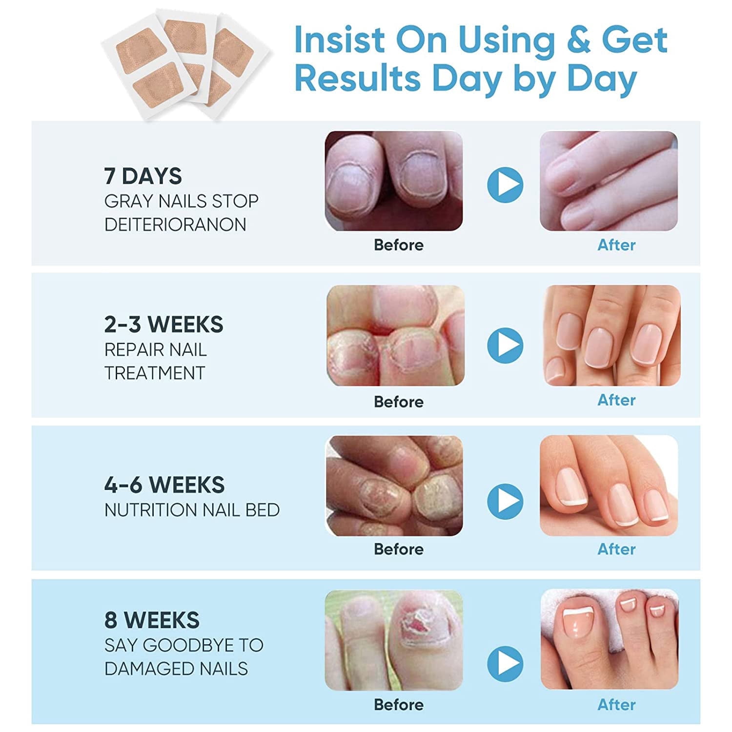 Toenail Fungus Treatment Extra Strength, 32 Pcs Toe Nail Fungus Treatment Extra Strength for Restores Appearance of Discolored or Damaged Nails